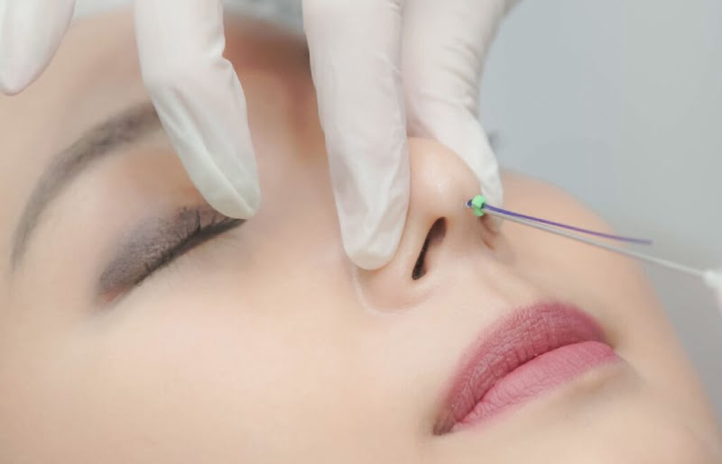 Có nên nâng mũi chỉ không