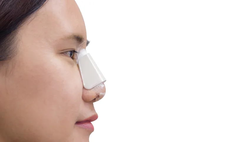 Nâng mũi có dễ bị lệch không