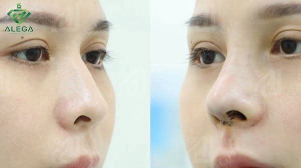 Khách hàng sửa mũi bị gồ thành công tại ALEGA
