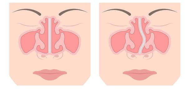Vẹo vách ngăn có nâng mũi được không? Bác sĩ ALEGA trả lời 2 Người bị vẹo vách ngăn