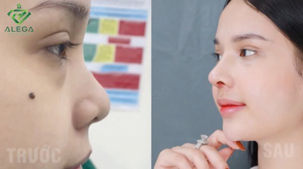 Bảng giá nâng mũi cấu trúc - Cập nhật mới nhất 2023 tại ALEGA 8 Trước và sau khi nâng mũi tại ALEGA