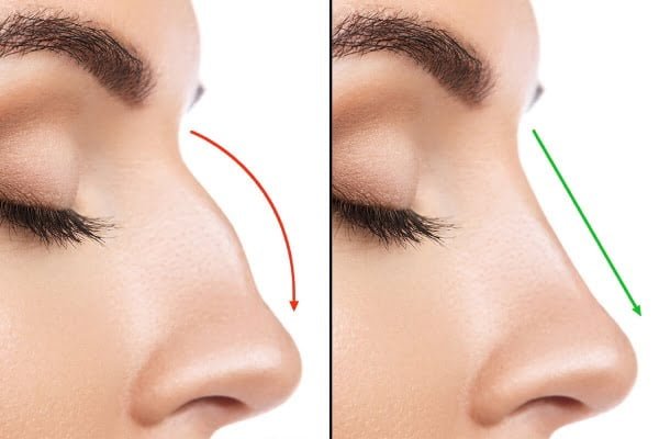 Trước và sau khi phẫu thuật 