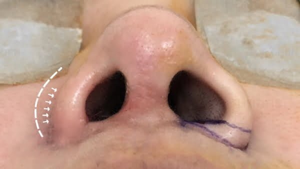 Nâng mũi bị sưng 1 bên