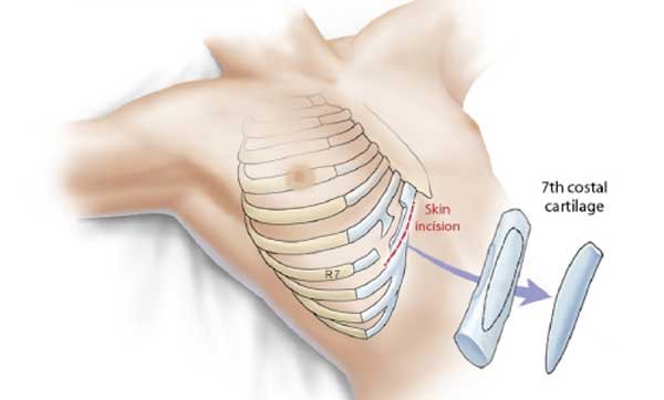 Thực hư nâng mũi sụn sườn có bị teo lại không? Bác sĩ tại ALEGA giải đáp 2 sụn sườn được sử dụng trong kỹ thuật nâng mũi sụn sườn