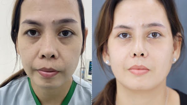 Nâng mũi thu gọn cánh mũi
