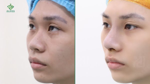ALEGA cập nhật bảng giá nâng mũi nam mới nhất 05/2023 7 Trước và sau khi nâng mũi