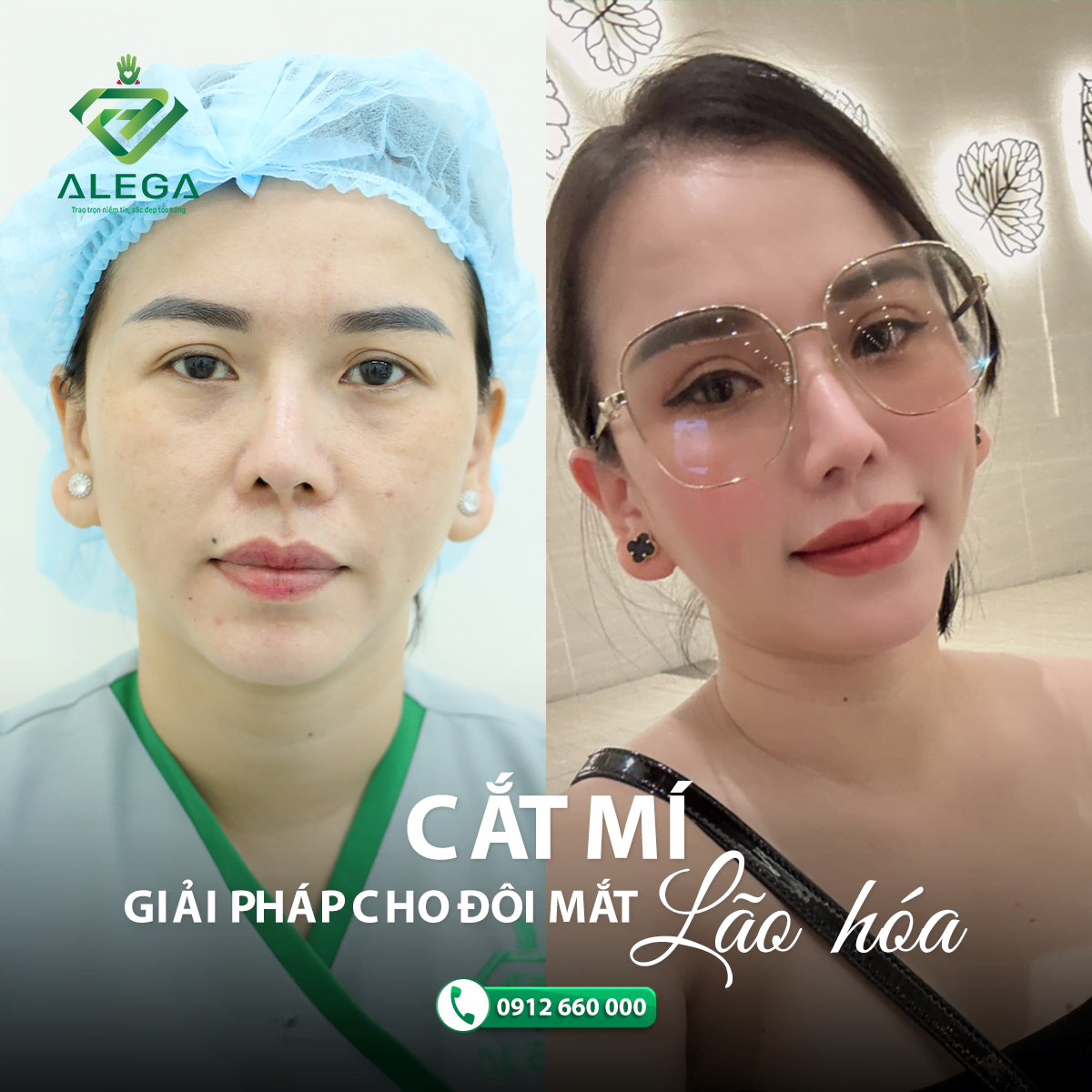 LỘT XÁC NHAN SẮC - GIẢM NGAY 30% KHI CẮT MẮT HOẶC ĐỘN CẰM 4 Hình ảnh khách hàng cắt mí mắt được 1 tháng