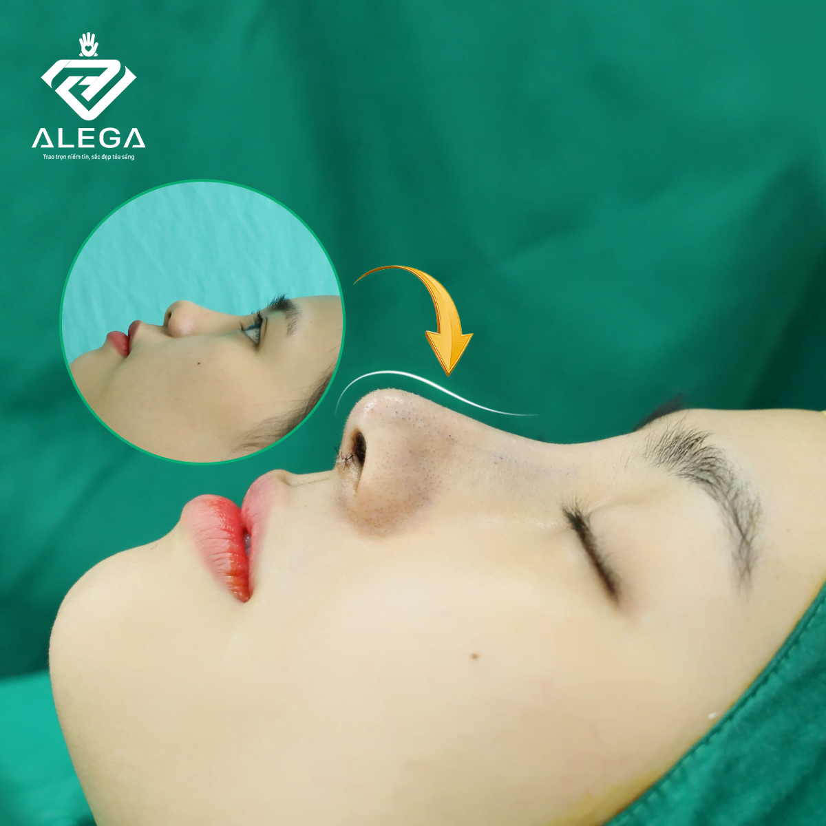 HỘI BẠN THÂN LÀM ĐẸP : NÂNG MŨI 2 - CHỈ TRẢ TIỀN 1 3 Hình ảnh khách hàng nâng mũi cấu trúc