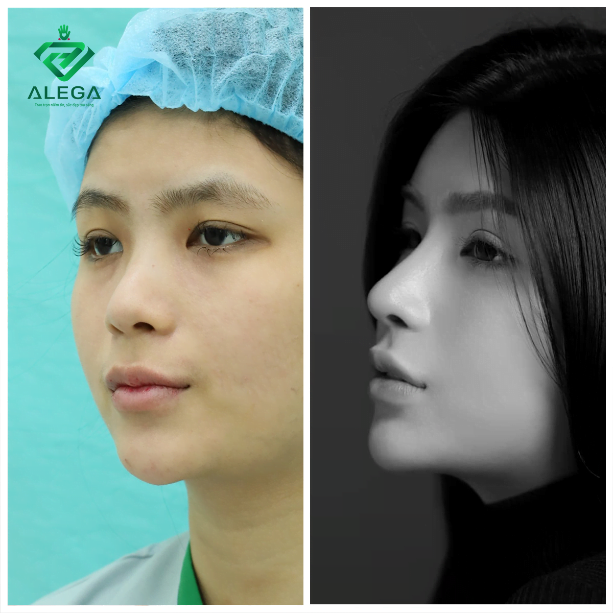 HỘI BẠN THÂN LÀM ĐẸP : NÂNG MŨI 2 - CHỈ TRẢ TIỀN 1 4 Hình ảnh khách hàng sau 1 tháng nâng mũi cấu trúc