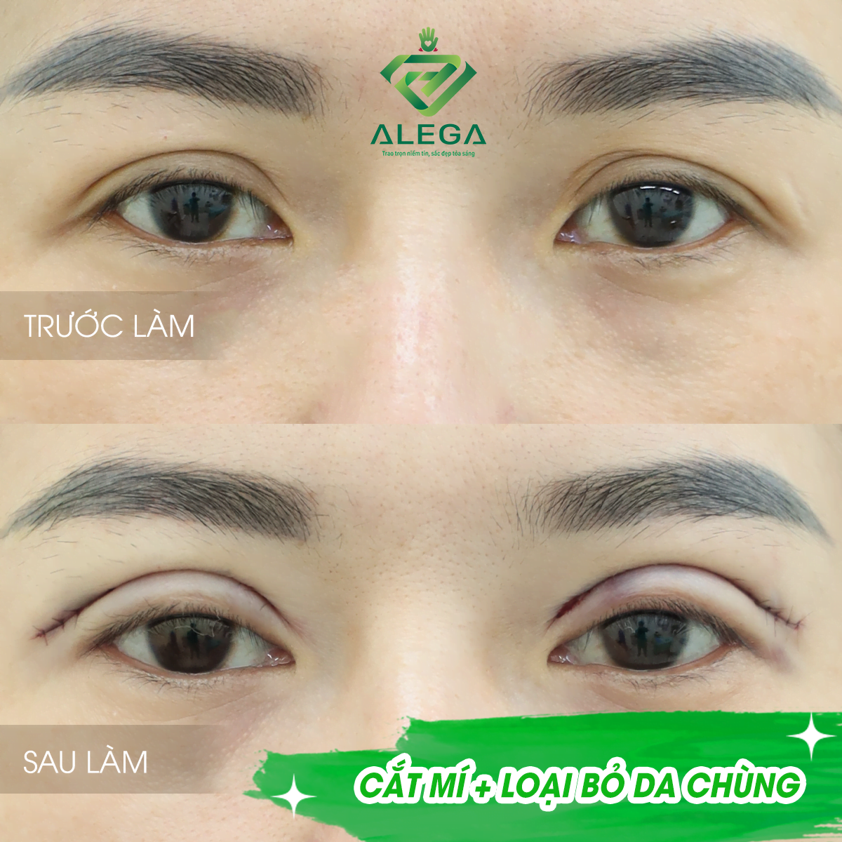 LỘT XÁC NHAN SẮC - GIẢM NGAY 30% KHI CẮT MẮT HOẶC ĐỘN CẰM 3 Hình ảnh khách hàng sau khi cắt mí mắt