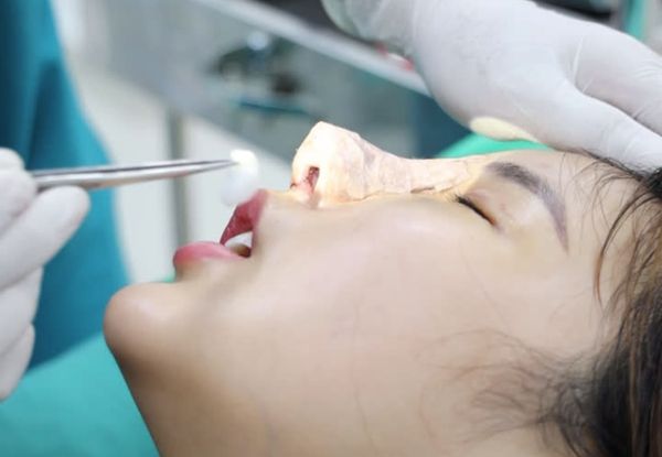 Vệ sinh vết thương thường xuyên