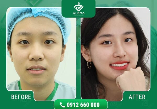 Hình ảnh khách hàng khi nâng mũi tại Alega