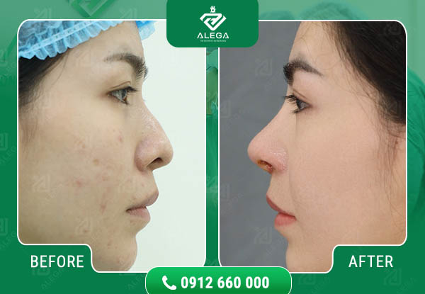Hình ảnh khách hàng khi trải nghiệm dịch vụ nâng mũi tại Alega