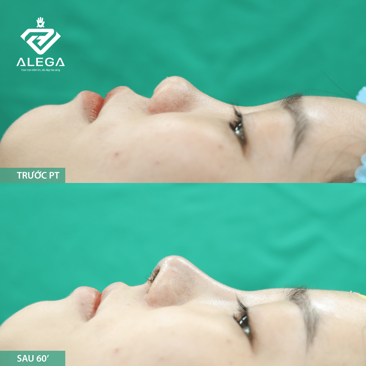 Hình ảnh khách hàng khi nâng mũi tại Alega