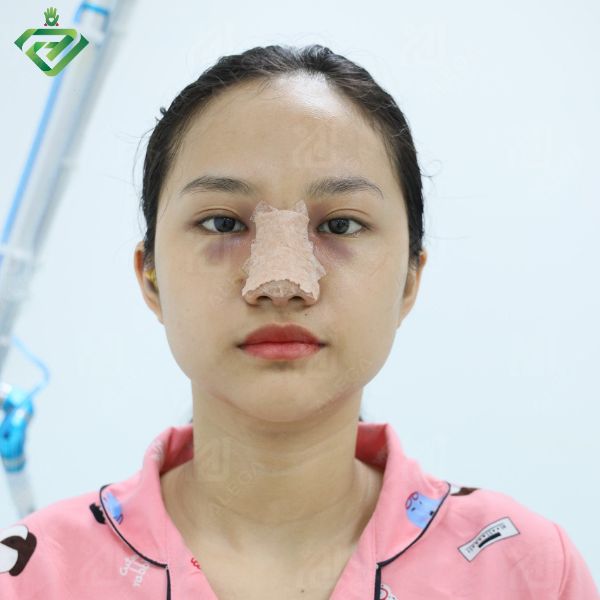 Sau nâng mũi làm sao để giảm sưng và giảm vết bầm