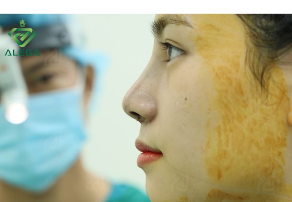 Xem trước dáng mũi trước khi đóng vết khâu