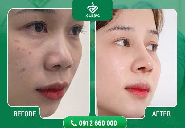Hình ảnh khách hàng khi nâng mũi tại Alega