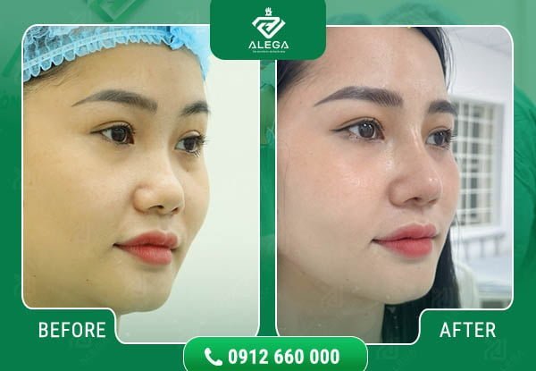 Hình ảnh khách hàng nâng mũi tại Alega