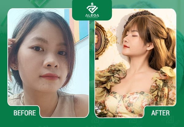 Sự khác nhau trước và sau khi thực hiện phẫu thuật nâng mũi tại Alega