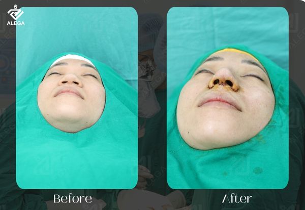 Cắt cánh mũi cần kiêng nước bao lâu