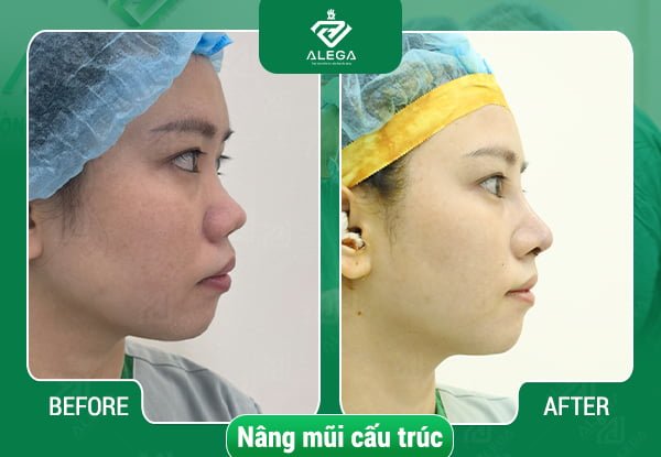 Hình ảnh khách hàng trước và sau khi nâng mũi