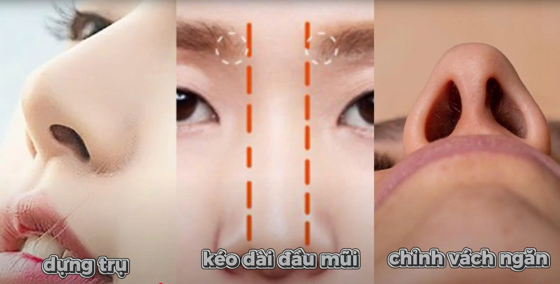 Nâng Mũi, Filler, Nâng Cấu Trúc: Lối Đi Đẹp Đúng Cách? 6 Nâng mũi cấu trúc: “đổi nền khung” mới bền lâu