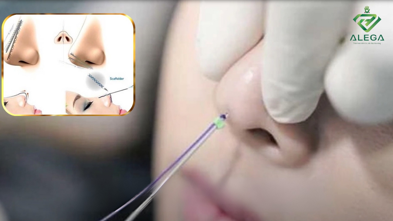 7 Phương Pháp Nâng Mũi Hiện Nay & Cách Chọn Phù Hợp 10 7 pp nang mui hieu qua