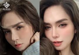 5 Nguyên Nhân Khiến Kết Quả Sau Nâng Mũi Không Như Mong Muốn 1 images