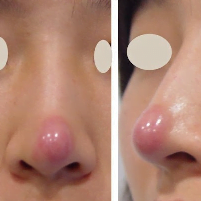 Sửa lại mũi hỏng 2 Bong do dau mui