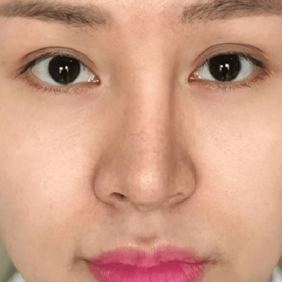 Sửa lại mũi hỏng 3 Lech song