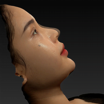 Nâng mũi Hàn Quốc 17 Mo phong 3d