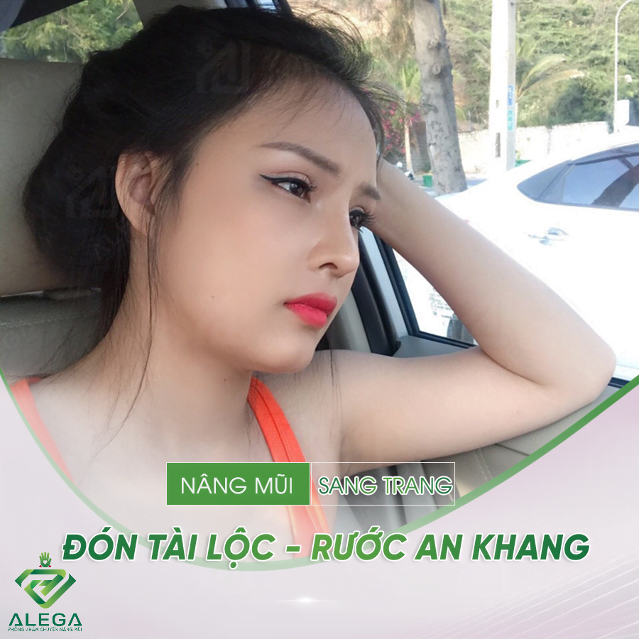 Nâng mũi Hàn Quốc 4 NC4