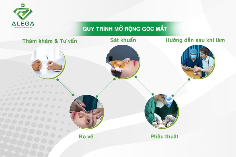 Mở rộng góc mắt 5 QUY TRINH THUC HIEN 3