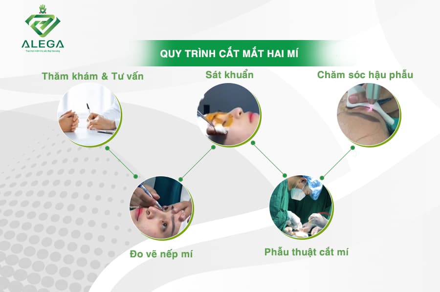 Cắt mí 4 Quy trinh cat mi