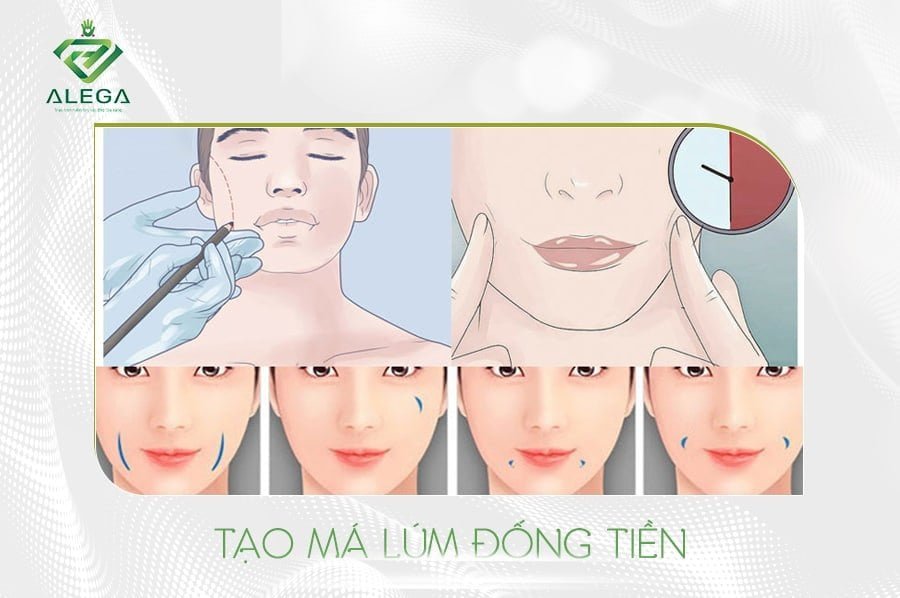 Tạo má lúm đồng tiền 2 Tao ma lum dong tien