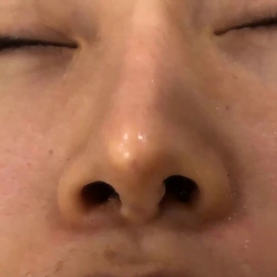 Sửa lại mũi hỏng 4 lo song