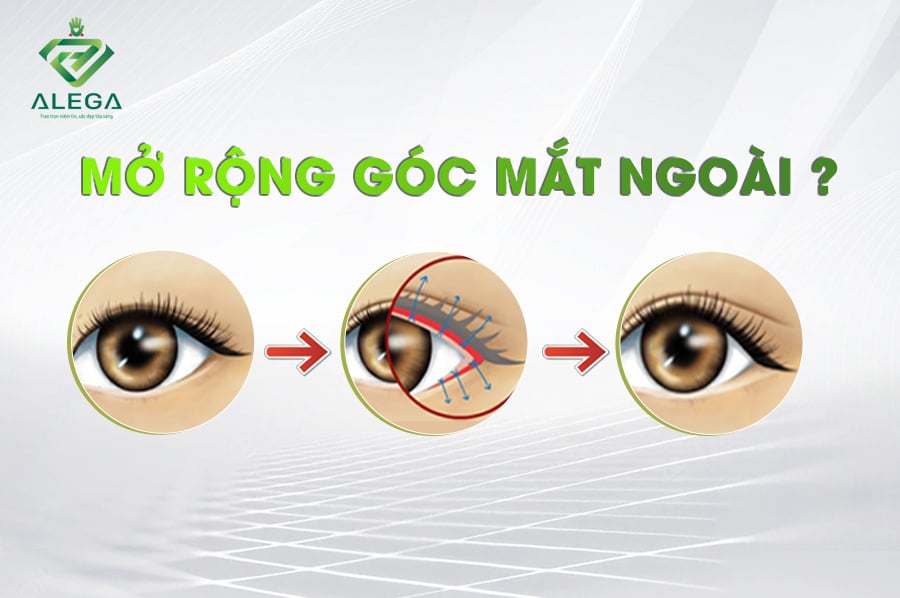 Mở rộng góc mắt 3 mO RONG GOC MAT NGOAI