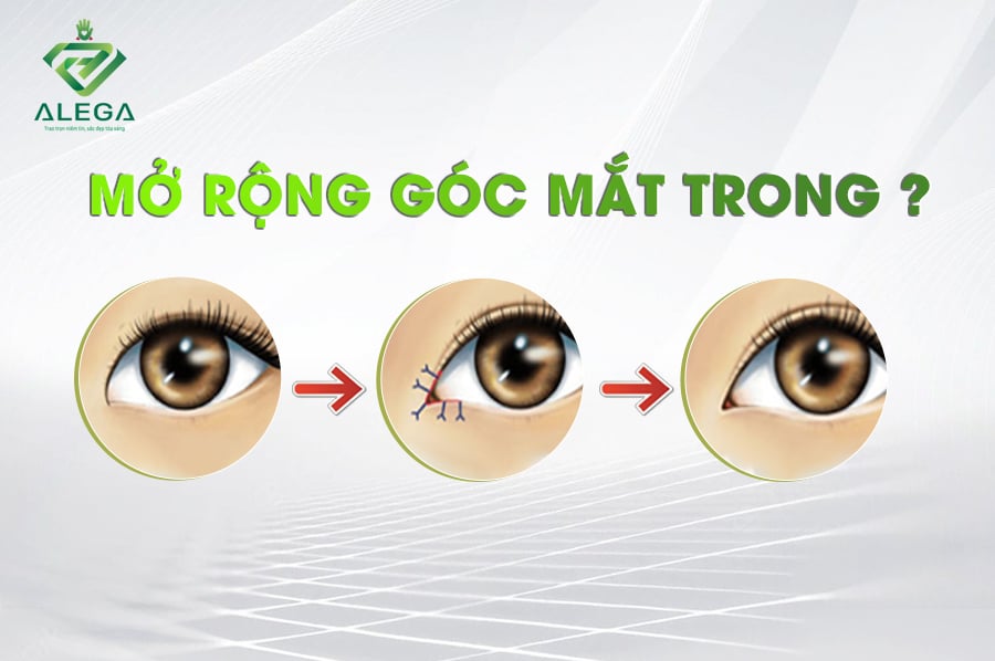 Mở rộng góc mắt 2 mO RONG GOC MAT TRONG